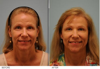 Short Term Botox