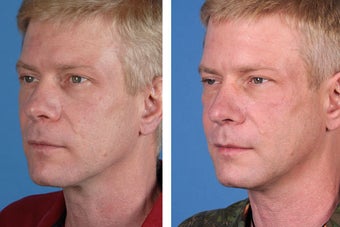 Radiesse, Restylane, Juvederm Plus & Botox Cosmetic