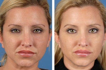 Botox Cosmetic & Restylane