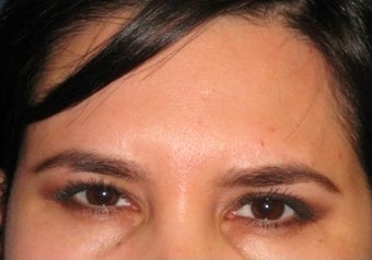 Botox