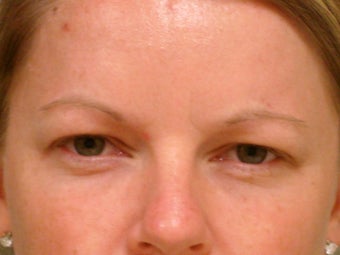 Botox Cosmetic