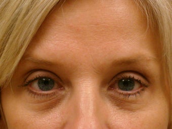 Botox Cosmetic