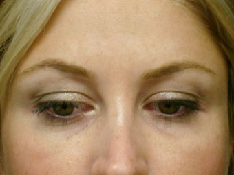 Botox Cosmetic