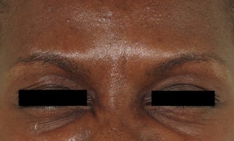 Botox