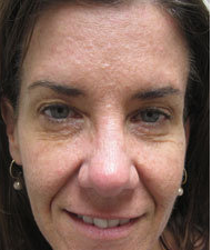 Botox