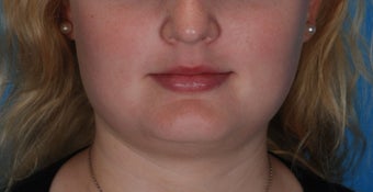Botox for enlarged jaw muscles