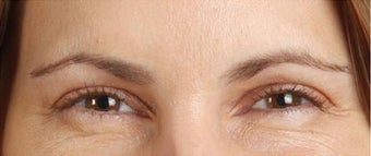 Botox