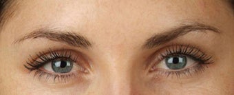 Botox