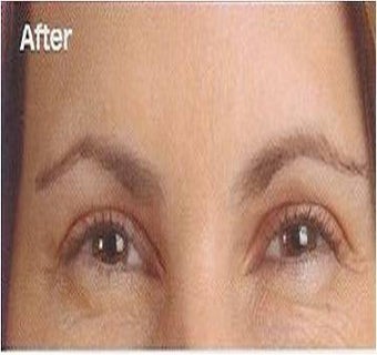 Botox