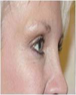 Botox