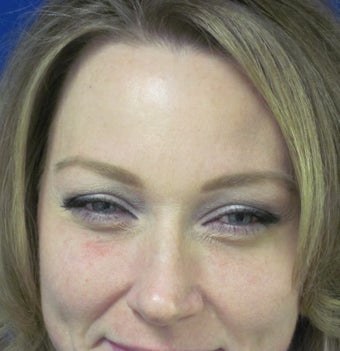 Botox