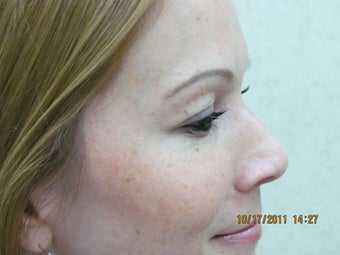 Botox for crow's feet