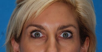Botox