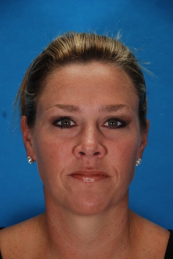 Botox