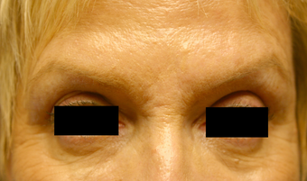 Botox & Restylane - Glabella 