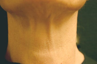 Botox 