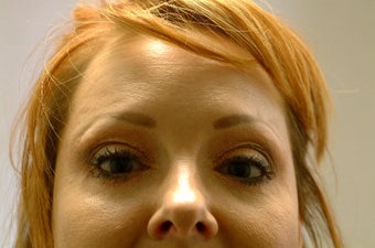 Botox