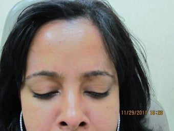 Botox for Frown Lines