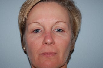 IPL Limelight Laser treatment, Pearl Laser Treatment and Botox