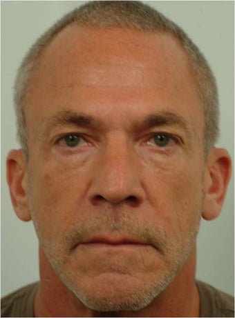 Botox between the eyebrows and across the forehead