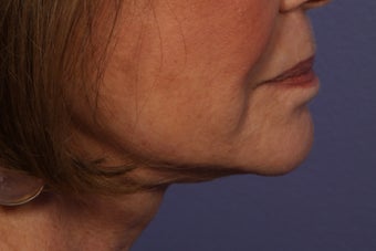 Botox to Neck (Platysmal Band Muscles)