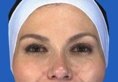 Botox Crow's Feet