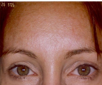 Botox