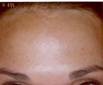 Botox