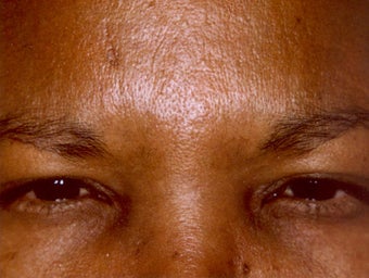 Botox