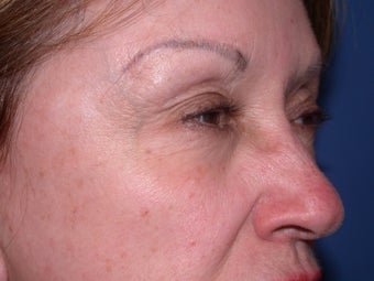 Before & After Botox Treatment