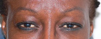 Botox for the frown lines