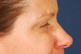 Botox Treatment of crow's feet