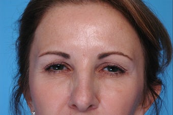 Botox