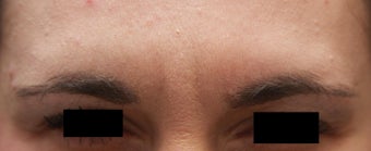 Frown Lines