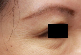 Crow's feet wrinkles