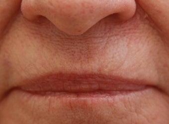 Upper Lip (whistle) lines