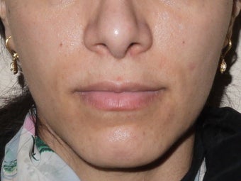 Botox Jawline Reduction