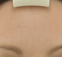 Forehead after Botox