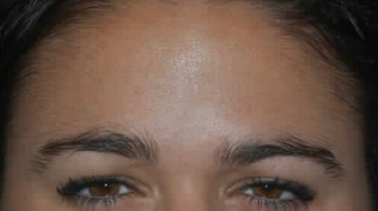 Botox to Treat Frown Lines and Vertical Lines Between Eyebrows