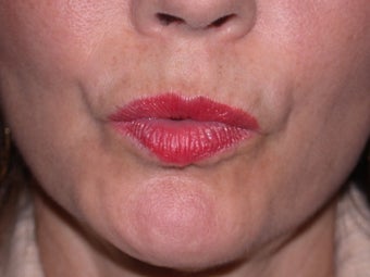 Before and After Botox to Upper Lip Lines
