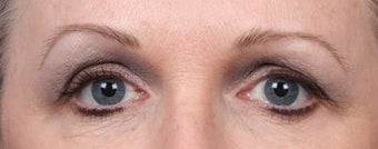 Botox and Dysport