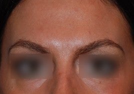Botox