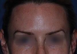 Botox