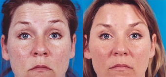 Botox