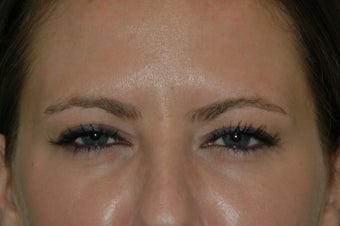Botox injected in between the eyebrows and into the forehead