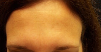 Botox Injections