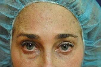 Botox