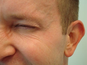 Botox- Crow's Feet