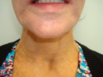 Botox