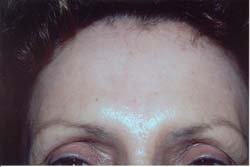 Botox